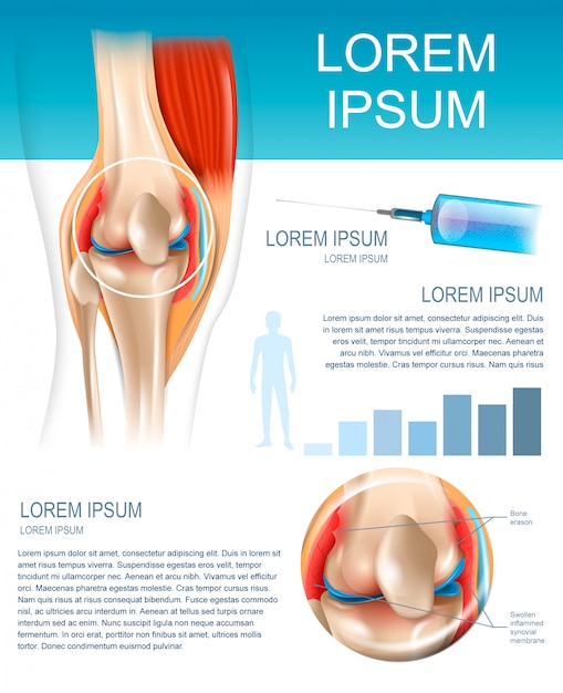Infograficzna metoda leczenia reumatoidalne zapalenie stawów Premium Wektorów