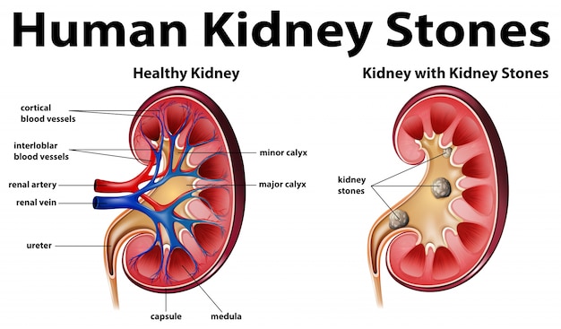 Schemat Anatomii Człowieka Z Kamieni Nerkowych Wektor