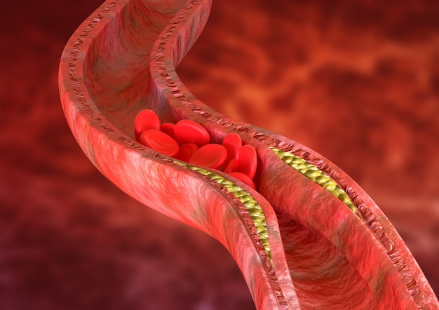 La Aterosclerosis Es Una Acumulación De Placas De Colesterol En Las Paredes De Las Arterias