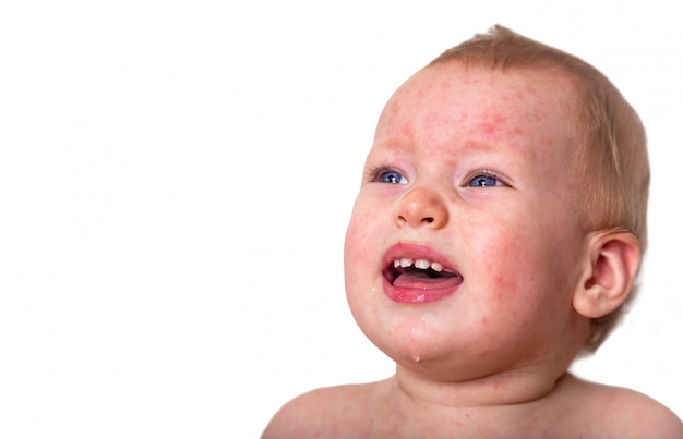 Imagenes De Roseola Vectores Fotos De Stock Y Psd Gratuitos