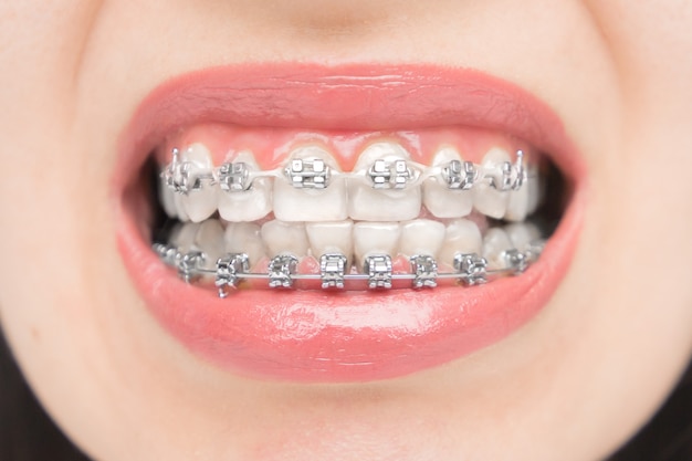 Cerca De Aparatos Dentales Brackets En Los Dientes Despues Del Blanqueamiento Soportes Autoligados Con Lazos Metalicos Y Elasticos Grises O Gomas Foto Premium