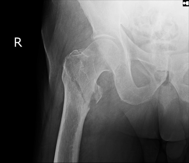 Imagen de la radiografía de la fractura de cadera | Foto Premium