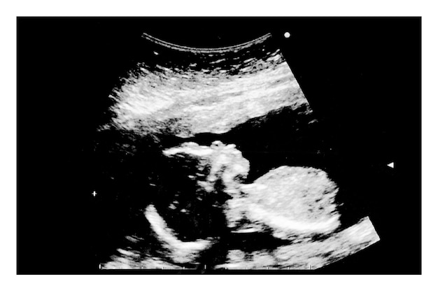 Imagen Del Ultrasonido Del Bebe En El Vientre Materno Foto Premium