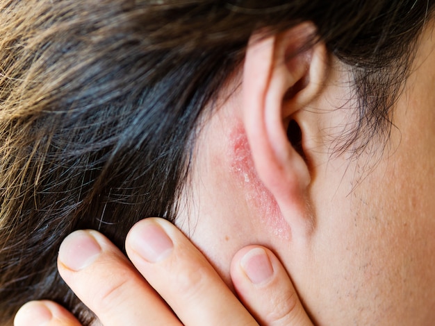 Irritacion En La Piel Detras De La Oreja Hombre De Piel Escamosa