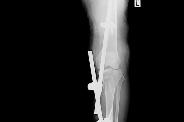 Mostrar Fractura De Tibia Y Perone Imagen De Rayos X De Fractura De Pierna Con Fijacion Externa Al Implante Foto Premium