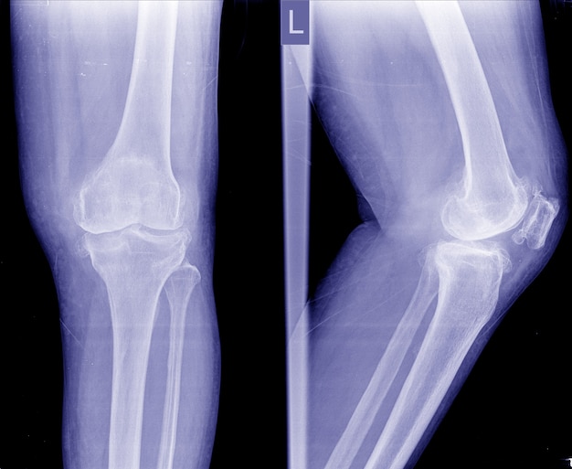 osteoartritis-oa-rodilla-radiograf-a-de-pel-cula-ap-y-vista-lateral