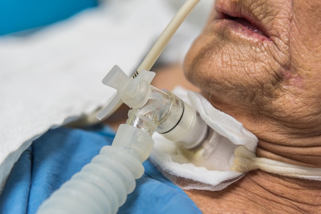 El Paciente Hace La Traqueotomía Y El Ventilador En El Hospital | Foto ...