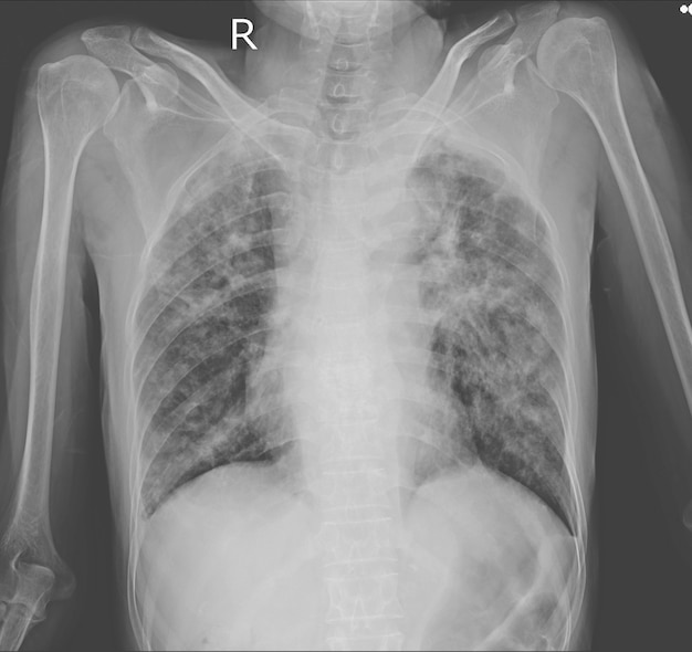 Radiografía de tórax infiltración pulmonar intersticial con cavidades ...