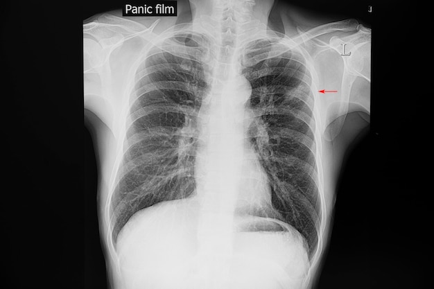 Radiografia De Torax Con Tuberculosis - Image to u