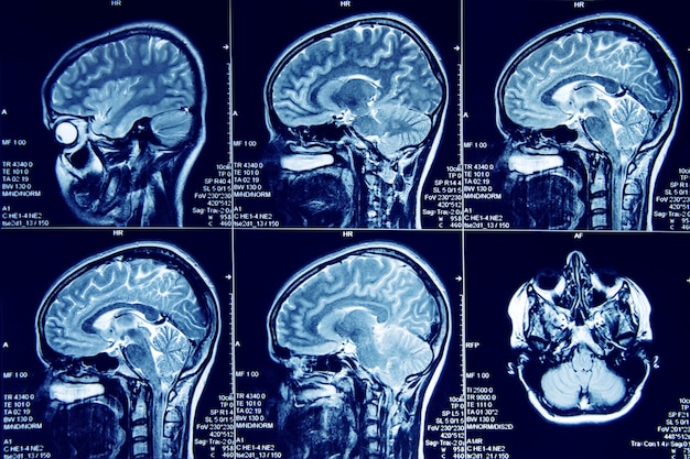 Resonancia Magnética Del Cerebro Humano En El Plano Sagital Foto Premium 3671