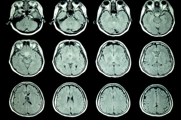 Resonancia magnética del cerebro del paciente Foto Premium