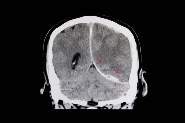 Tomografía Computarizada De Un Cerebro De Un Paciente Con Hemorragia