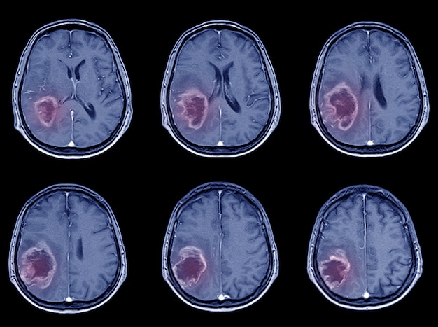 Tomografía computarizada de exploración por tomografía computarizada para el accidente cerebrovascular hemorrágico o accidente cerebrovascular isquémico. Foto Premium