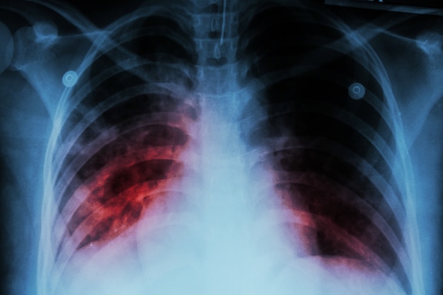 tuberculosis pulmonar tb radiografía de tórax muestra infiltración