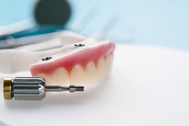 Impianti dentali che supportano overdenture su sfondo blu. Foto Premium