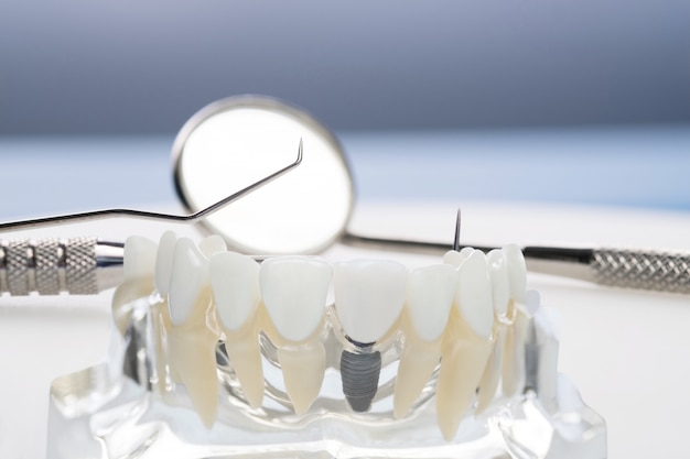 Modello e strumenti di impianto e ortodonzia per gli studenti all'apprendimento del modello di insegnamento che mostra i denti. Foto Premium