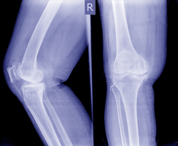 A radiografia de filme ap anterossuperior e a visão lateral do joelho mostram um espaço