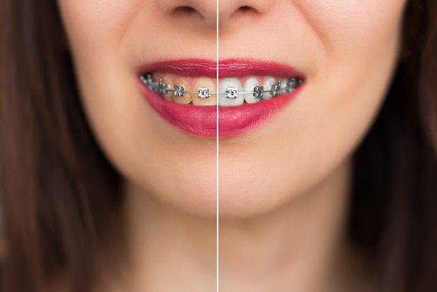 Os tipos de clareamento dental