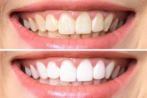 Dentes antes e depois do clareamento | Foto Premium