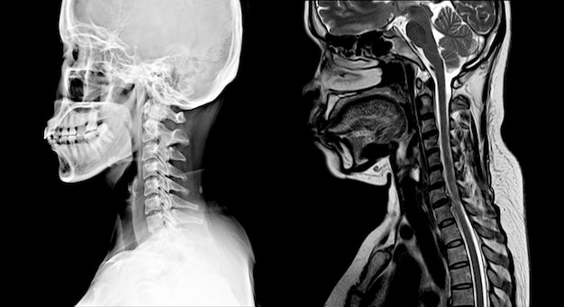 Imagem da coluna cervical radiografia e ressonância magnética normal: mostrando espaço discal estreito c4-5 com erosão e esclerose das placas terminais Foto Premium