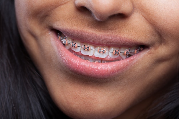 Mulher que sorri com aparelho de dentes Foto Grátis