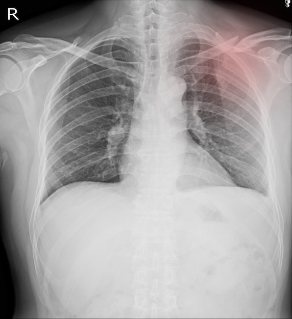 Radiografia De T Rax Fraturas Deixadas Clav Cula Costela Anterior