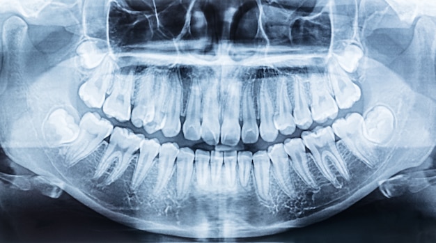 Radiografia dentária panorâmica de uma boca esquerda e direita. | Foto