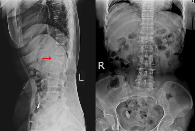 raio-x-ls-spine-ap-lateral-localiza-o-fratura-por-compress-o-moderada