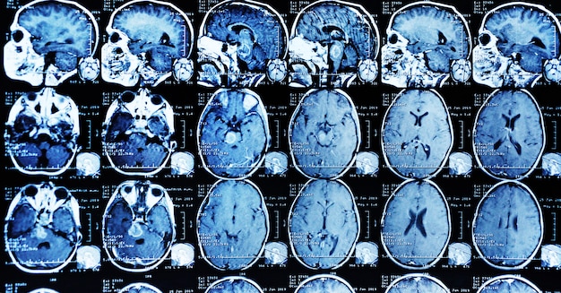 Ressonância magnética de um paciente com um tumor no tronco cerebral. Foto Premium