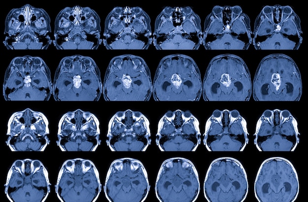 Ressonância Magnética Do Cérebro Com E Sem Meio De Contraste Resultados Há Uma Massa Lobulada 2671