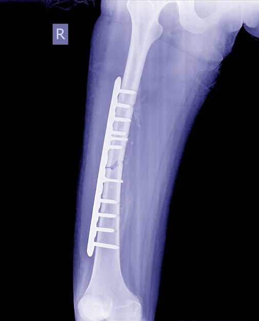 Gebrochenes Bein Rontgt Bild Rontgenbild Des Bruchbeines Mit Implantatplatte Und Schraube Premium Foto