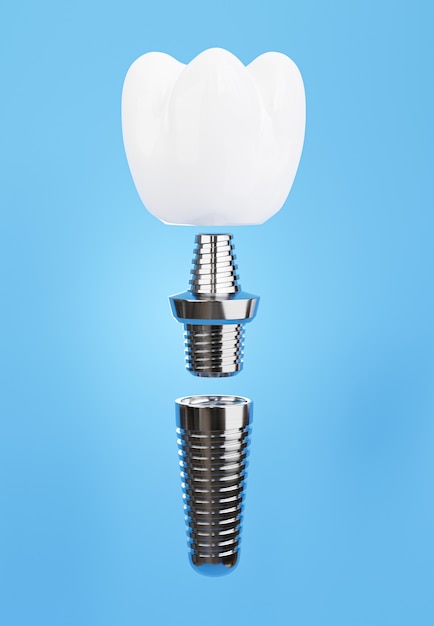 Premium Photo | 3d render of dental implant assembly on blue background