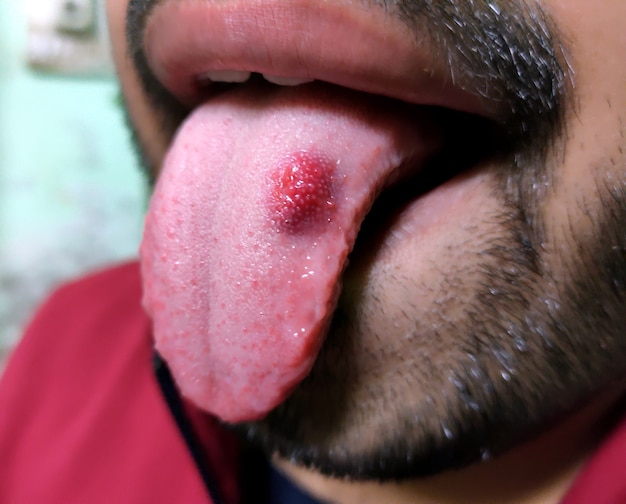 赤い斑点が光沢のある病気の舌のクローズアップ 舌の灼熱感と不快感 プレミアム写真
