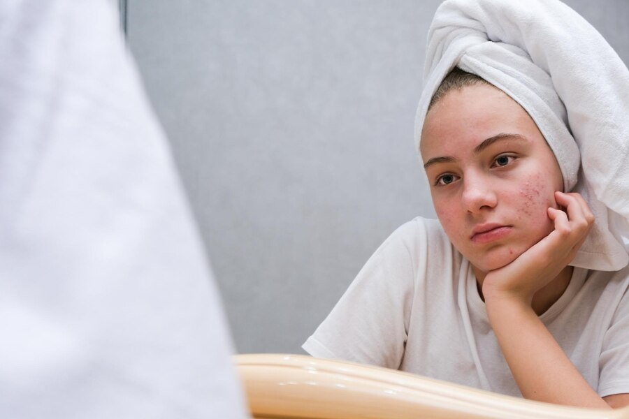 Premium Photo | Acne. a sad teenage girl. problematic skin in adolescents.