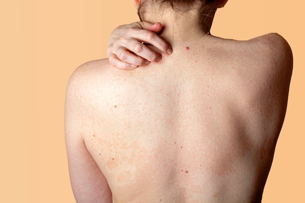 女性の背中の皮膚のアレルギー性皮膚炎 皮膚疾患 神経皮膚炎 湿疹またはアレルギー性発疹 ヘルスケアと医療 皮膚の落屑 プレミアム写真