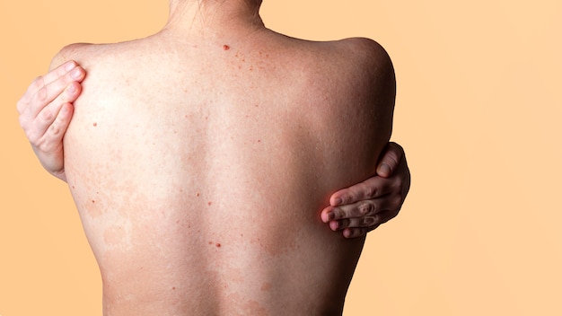 女性の背中の皮膚のアレルギー性皮膚炎 皮膚疾患 神経皮膚炎 湿疹またはアレルギー性発疹 ヘルスケアと医療 プレミアム写真