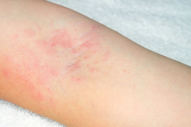 Allergy to red rash on the arms on white background Photo | Premium ...