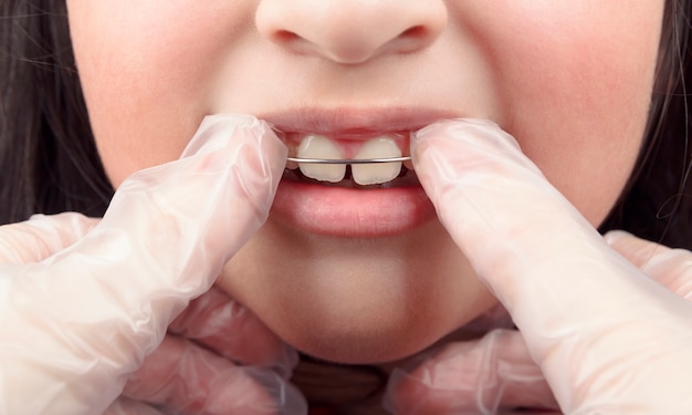 歯科矯正医が女の子の歯に歯科矯正器具を置きます プレミアム写真