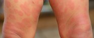 Premium Photo Baby Legs With Rash