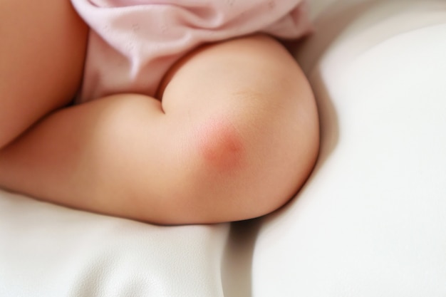 赤ちゃんの皮膚の発疹と 膝の蚊に刺されたことが原因の赤い斑点を伴うアレルギー プレミアム写真