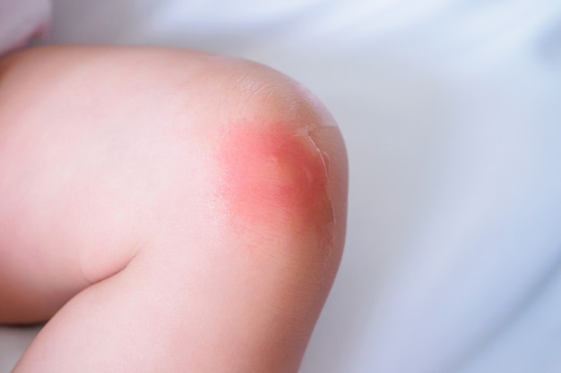 赤ちゃんの皮膚の発疹と 膝の蚊に刺されたことによる赤い斑点のあるアレルギー プレミアム写真