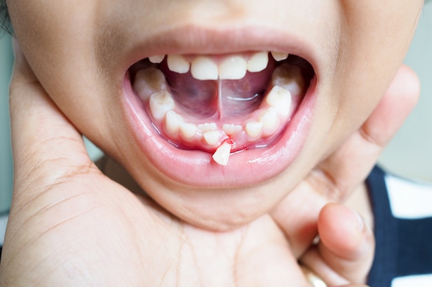 Baby tooth of asian thai girl children with teeth dropped ...