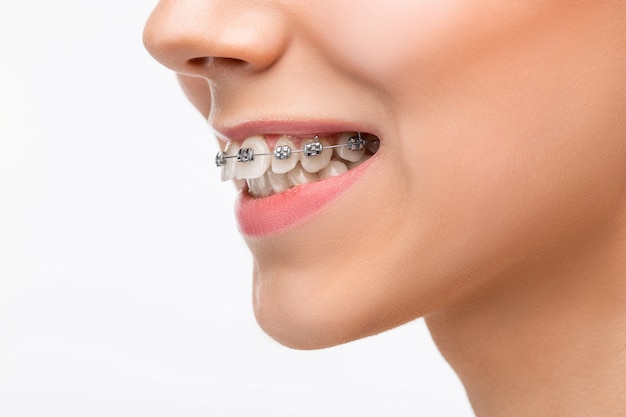 Benefits of braces besides straight teeth