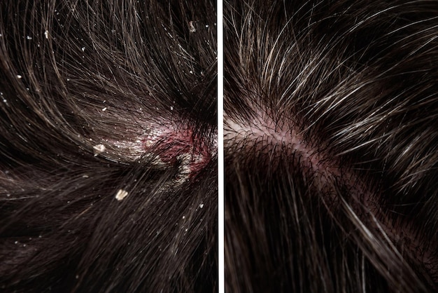 Premium Photo | Before and after dandruff treatment shampoo on hair ...