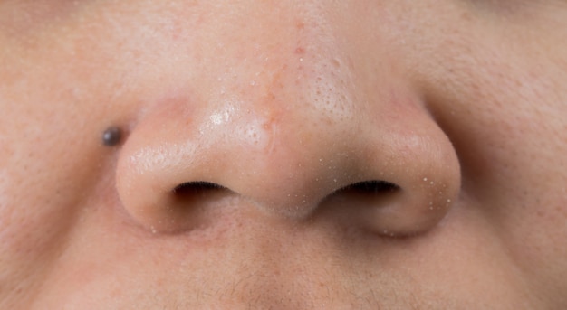 アジアの女性の鼻ににきびにきび 鼻の先端の傷跡 開いた面dと大きな毛穴の皮膚には 治療のためにaha Bhaまたは過酸化ベンゾイルが必要です プレミアム写真