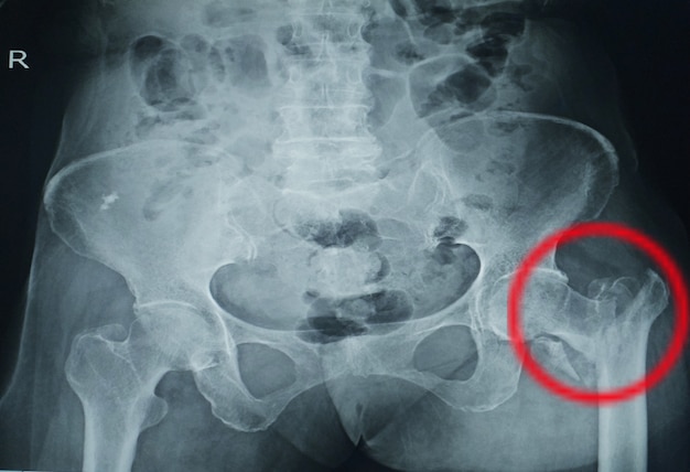 Both hips x-ray a female 78 year old finding comminuted intertrochanteric fracture at left proximal femur. Premium Photo