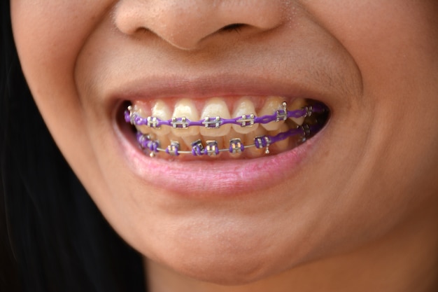 Premium Photo Braces Purple In Mouth Woman 