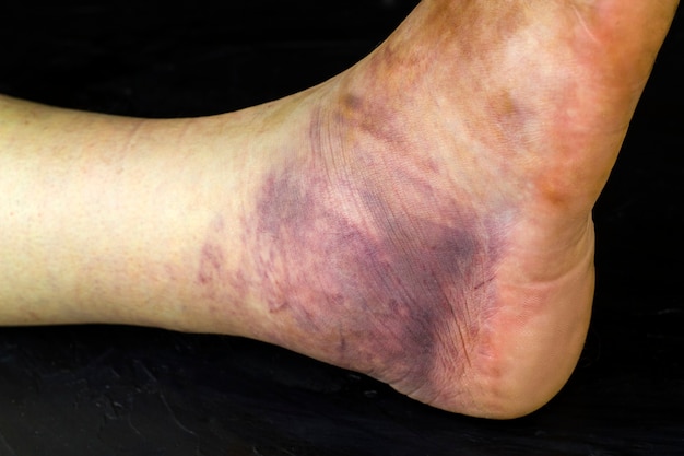 premium-photo-broken-human-ankle-huge-purple-bruise-on-a-man-s-leg