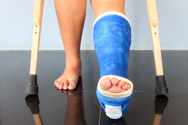 Premium Photo | Broken leg in a plaster cast with soft-focus in the ...