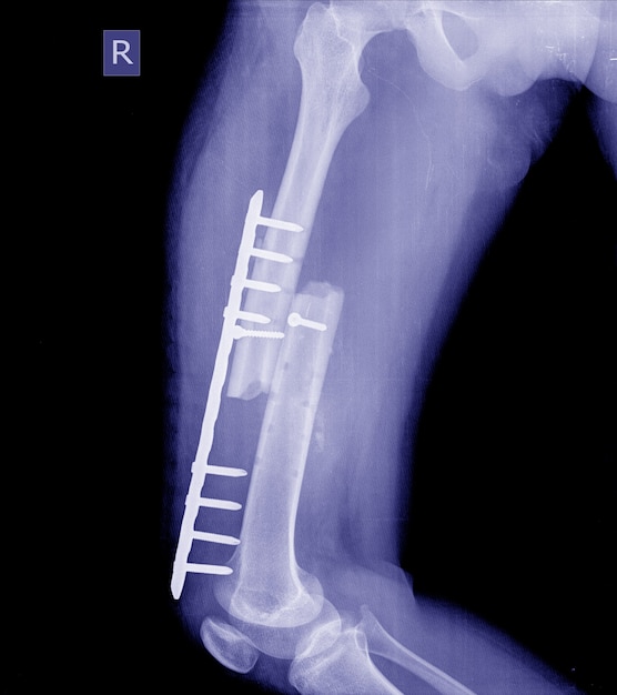 Leg Fracture X Ray